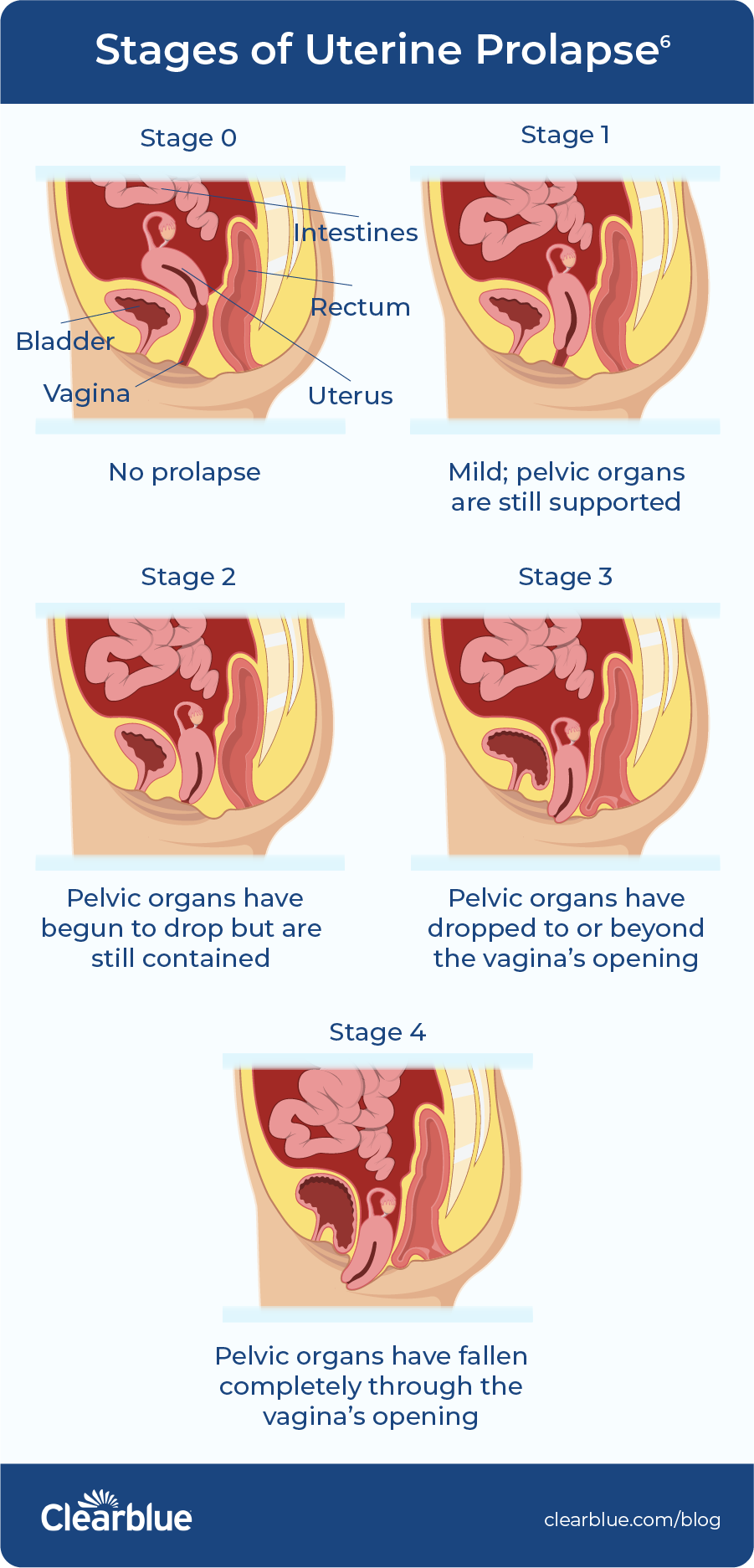 What is pelvic organ prolapse? — Clearblue®