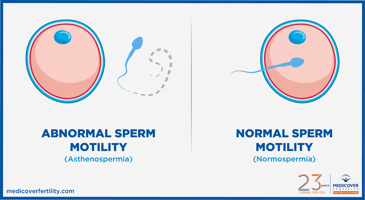 what causes low sperm motility